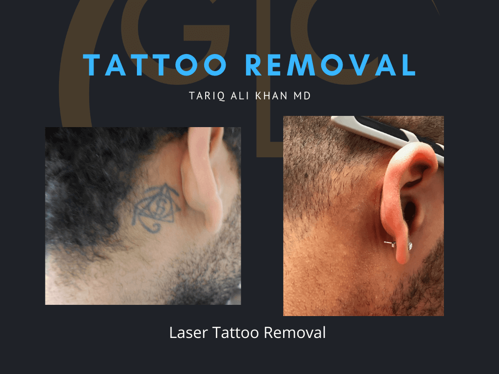 Gentle Care Laser Tustin Before and After picture - Tattoo Removal